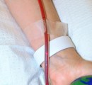 eboo-device-removing-debris-from-patients-blood