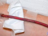 EBOO treatment IV filled with toxic debris.