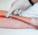During an EBOO treatment a nurse wiggles with the IV line to get the thick debris flowing.
