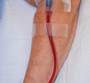 Bright red purified blood going back into the patient's arm.
