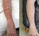 Before and after photo of a patient who had 12 sessions of ozone therapy and his Disseminated superficial actinic porokeratosis (DSAP) healed.