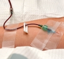 Ozone Therapy IV in Patient's Arm