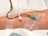 Ozone Therapy IV in Patient's Arm