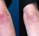 Before and after psoriasis on the right elbow being significantly reduced with ozone therapy.