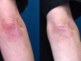 Before and after psoriasis on the right elbow being significantly reduced with ozone therapy.