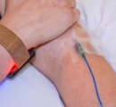 Patient with photo-dynamic therapy wrist light and IV Methylene Blue.
