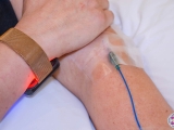 Patient with photo-dynamic therapy wrist light and IV Methylene Blue.