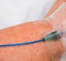 Close-up of IV filled with methylene blue in patient's arm.