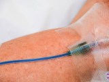 Close-up of IV filled with methylene blue in patient's arm.