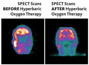 SPECT (Single-photon emission computerized tomography) scans of the brain before and after hyperbaric oxygen therapy.