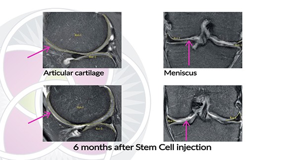 MRI of cartilage in the knee being regenerated with the use of stem cells.