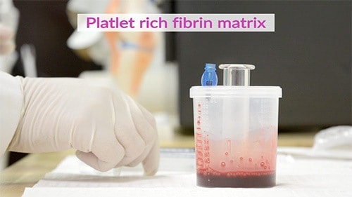 Platelet rich fibrin matrix.