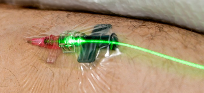 Green Weber laser intravenous low level laser light therapy
