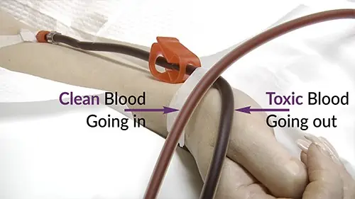 The toxic blood comes out of one arm, goes through the EBOO device, is filtered and ozonated, then the cleansed and ozonated blood goes into the other arm.