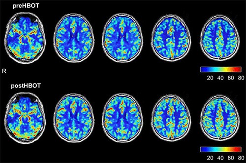 Brain perfusion magnetic resonance imaging before and after hyperbaric oxygen therapy. The upper row represents brain perfusion 3 months after the Covid infection, before HBOT. The lower row represents the perfusion magnetic resonance imaging done after completing the HBOT protocol.