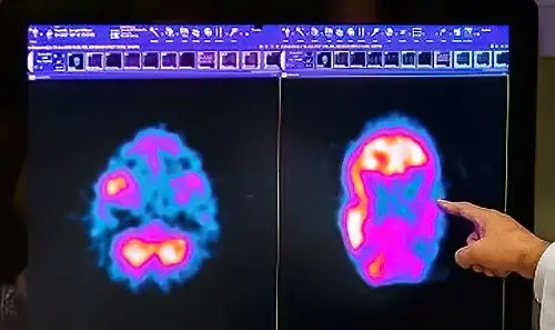 Brain scans before and after hyperbaric oxygen therapy.