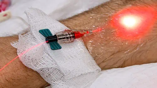 Intravenous low level light therapy with Weber Laser