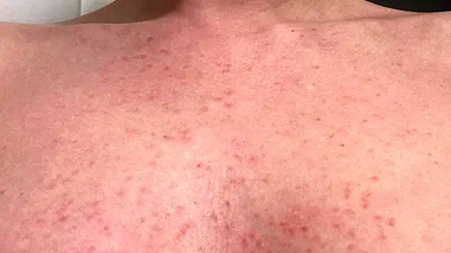 COVID-19 Vaccine-induced rash.