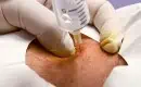 thumbs_close-up-of-ozone-injection-in-elbow-of-patient