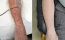 thumbs_dsap-disseminated-superficial-actinic-porokeratosis-before-after-treatment-