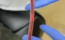 thumbs_eboo-nurse-holding-tubing-containing-debris-removed-from-patients-blood-ama-regenerative-medicine