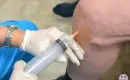 thumbs_ozone-injection-into-knee-ama-regenerative-medicine