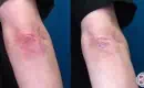 thumbs_psoriasis-before-and-after-ozone-therapy
