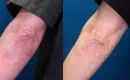 thumbs_psoriasis-before-and-after-ozone-therapy2