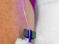 Close-up of intravenous blue light therapy (photobiomodulation) being administered for Long COVID treatment.