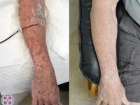 dsap-disseminated-superficial-actinic-porokeratosis-before-after-treatment