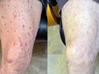 Before-and-after photo showing a patient's leg skin clearing dramatically after Ozone Therapy treatment for DSAP.