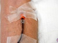 eboo-therapy-iv-blood-going-out