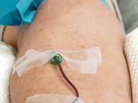 Close-up of the patient's arm showing the IV line insertion site for Hyperbaric Ozone Therapy treatment.