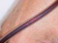 long-covid-patient-shows-debris-being-removed-from-blood-by-eboo-device-ama-regenerative-medicine-copy