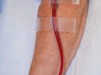 Filtered, oxygenated, and ozonated blood safely returned to a Long COVID patient's arm after the EBOO treatment phase.