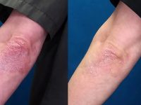 psoriasis-before-and-after-ozone-therapy2