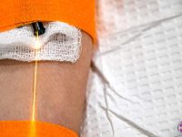 yellow-intravenous-laser-light-therapy-photobiomodulation-weber-iv