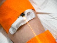 yellow-laser-light-therapy-photobiomodulation-weber-intravenous