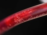 Close-up of the debris in the blood of a COVID vaccine injured patient during EBOO treatment.