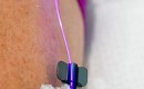Close-up of blue light intravenous therapy from Weber laser.