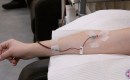 The IV line during a high dose or 10 pass ozone therapy treatment.