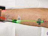 Lyme patient receives intravenous low level laser therapy in the green spectrum