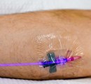 Blue low level laser therapy with Weber Laser