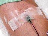 An IV in a Long COVID patient's arm that is used for Major Autohemotherapy (MAH) ozone therapy treatment.