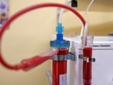 Stratos EBOO ozone therapy device filtering the blood of a Long COVID patient.