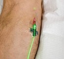 weber-green-intravenous-laser-ama-regen-med