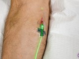 Weber green intravenous low level light therapy in patient's arm