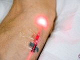 Intravenous red low level light therepy IV in patient's arm.
