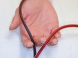 Patients holds the two IV lines used during an EBOO /F treatment
