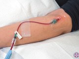 Single dose ozone therapy iv line in patients arm